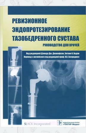  Ревизионное эндопротезирование тазобедренного сустава